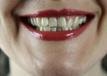 Brown stains on teeth