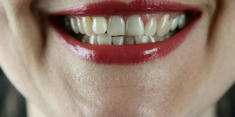 Brown stains on teeth